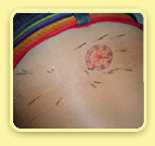 Acupuncture