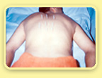 Acupuncture