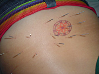 Acupuncture